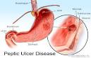 Peptic Ulcers including gastric ulcer, duodenal ulcer and ...