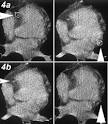 <b>arteriosclerosis coronaria</b>