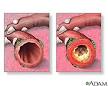 Chronic Bronchitis: MedlinePlus