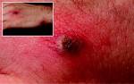 Disseminated gonococcal infection in a homosexual man diagnosed by ...