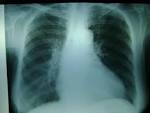¿<b>cardiomegalia</b>?