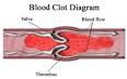 Thrombus - Wikipedia, the free encyclopedia