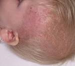cell <b>histiocytosis</b> in a