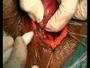 Colloid Thyroid
