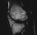 Bone Bruise Sign