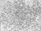 POLYOMA <b>VIRUS</b> (<b>BK VIRUS</b> and JC