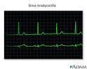 About Bionics &amp; Histrionics II: Asymptomatic Bradycardia