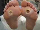 <b>Diabetic Foot</b> Problems
