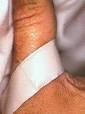 Blisters