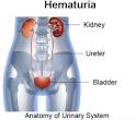Hematuria | Medindia