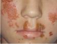 çocuklarda sulu yaralar impetigo nedir impetigo nedenleri ve tedavisi