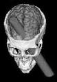 Traumatic <b>Brain Injury</b>: Hope