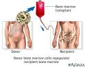 <b>Bone</b>-<b>marrow transplants</b>