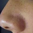 Blackhead - Wikipedia, the free encyclopedia