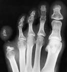37.8 <b>Ainhum</b> in a patient from