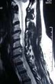 Explaining Spinal Disorders: Cervical Disc Herniation