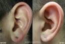 Earlobe Repair Plano, Torn Earlobe Repair, Cosmetic Surgery ...
