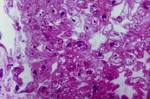 y <b>leucocitos mononucleares</b>
