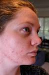 #9 You get acne because you