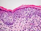 Lymphoma - Non B cell neoplasms - <b>Mycosis fungoides</b>