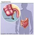 <b>Appendicitis</b> Symptoms, Causes, Surgery, and Recovery