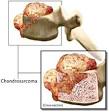 Back.com - Causes - Tumors
