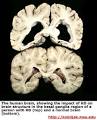 Huntington's Disease (HD)