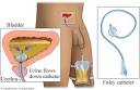 El Sondaje Vesical. | APUNTES AUXILIAR ENFERMERIA