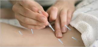 Back Pain With Acupuncture