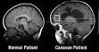 with <b>Canavan disease</b>.