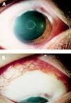 Amniotic membrane transplantation for necrotising conjunctival ...