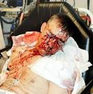 Raoul Moat's police officer victim releases horrific picture of ...