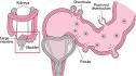 DIVERTICULITIS: Diverticular Disease: Merck Manual Home Edition