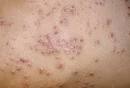 <b>Eczema</b> and Infection