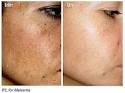 Melasma before and after.
