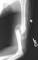 midshaft <b>humerus fracture</b>