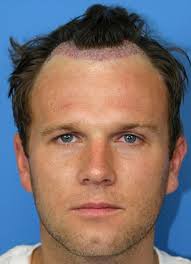 Spencer Stevenson: Man who beat baldness advises A-list celebrities on hair transplants | Mail Online - article-2156861-13870EF7000005DC-567_306x423