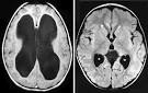 Hydrocephalus | Seattle Children's Hospital
