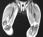 MR Imaging of Primary Skeletal Muscle Diseases in Children