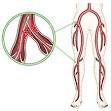 Deep Vein Thrombosis - OrthoInfo - AAOS