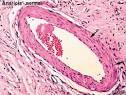 Patoarte Alterações Hialinas Arterioloesclerose