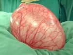 Usually ovarian <b>cysts</b> are