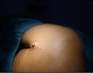 File:Infected sebaceous cyst on back.jpg - Wikipedia, the free ...