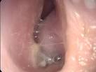 A <b>obstrução nasal</b> geralmente