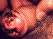 Tumor de <b>Pênis</b>