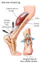 The Achilles <b>tendon</b> is the