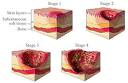 pressure sore death lawyer, bedsores attorney, decubitus ulcers ...
