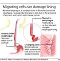 spike in esophageal cancer
