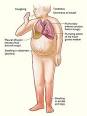 Heart failure - Wikipedia, the free encyclopedia
