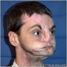 Extensive-Face-Transplant-1